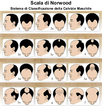 medea-capelli-tricologia-chirurgica-scala-di-norwood-calvizie-maschile